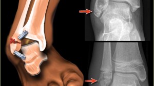 How To Treat An Ankle Fracture