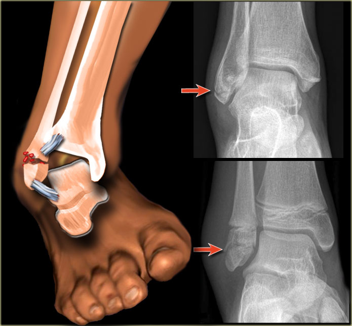 How To Treat An Ankle Fracture